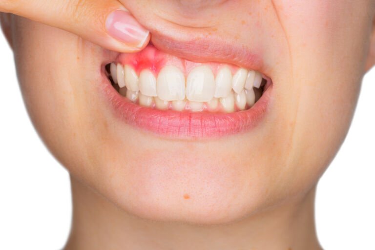 Gingii inflamate și dureroase. Ce trebuie să știi despre gingivită? Gingii inflamate și dureroase. Ce trebuie să știi despre gingivită?