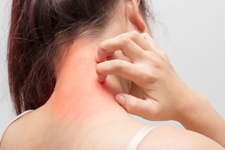 Soluții de tratament pentru dermatita atopică Soluții de tratament pentru dermatita atopică